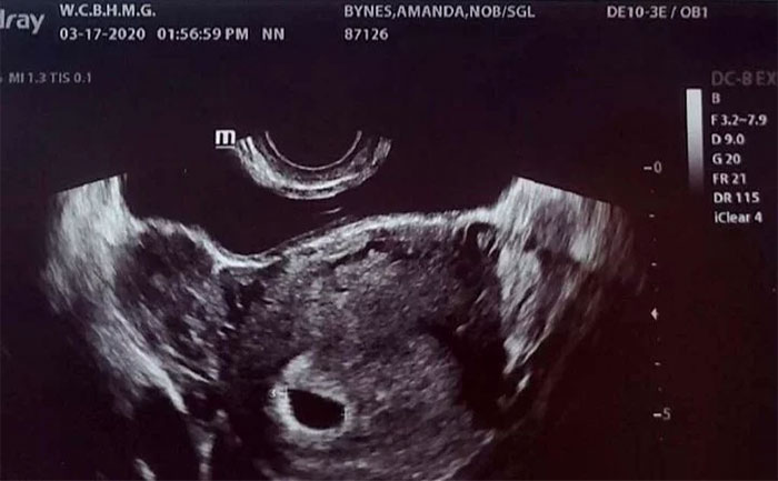 Amanda Bynes pregnancy ultrasound _TLM