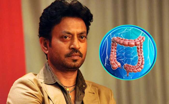 colon infection explained